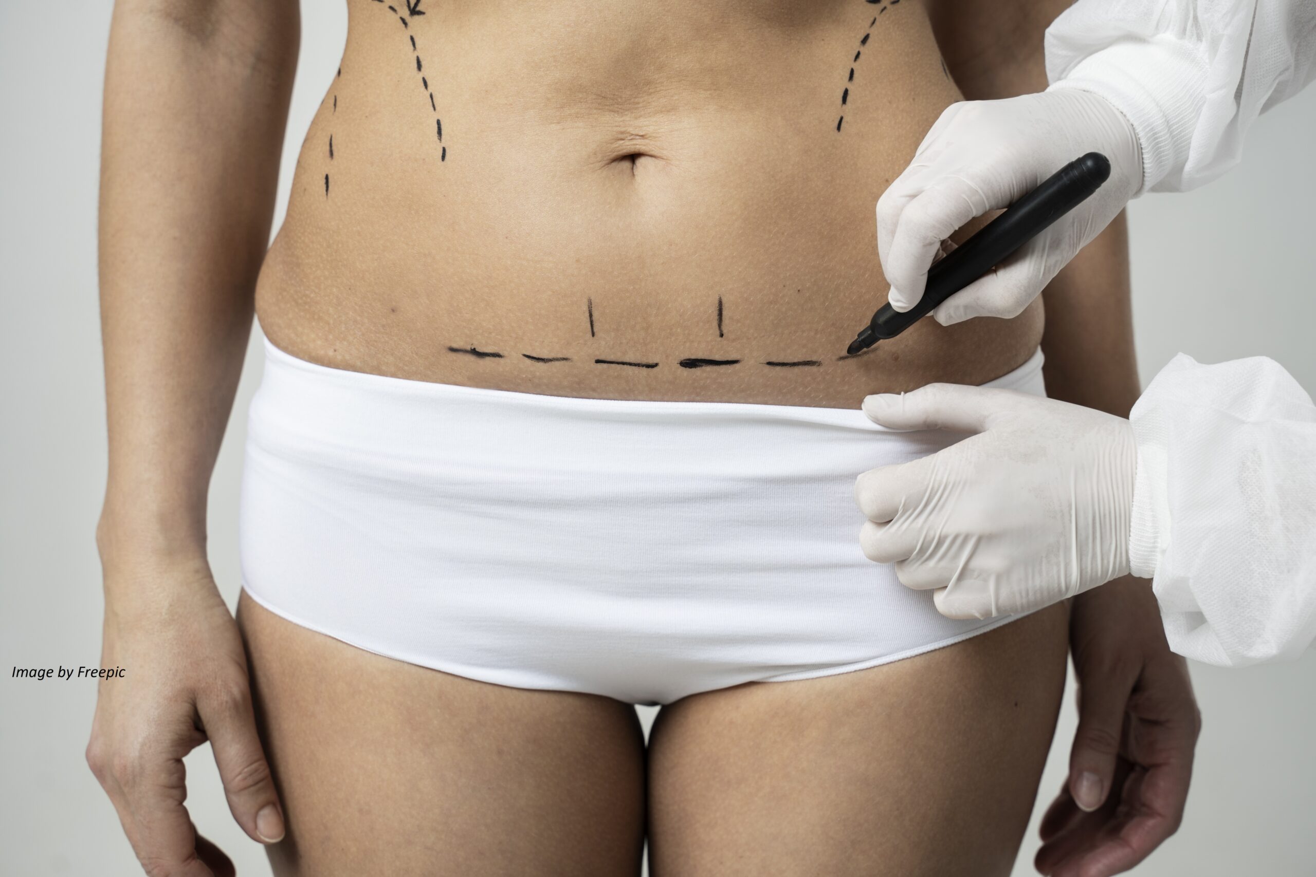 Abdominoplasty or tummy tuck