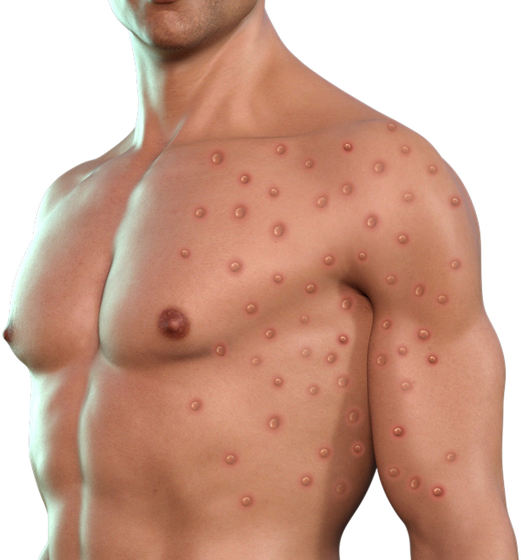 MPOX Symptoms and causes