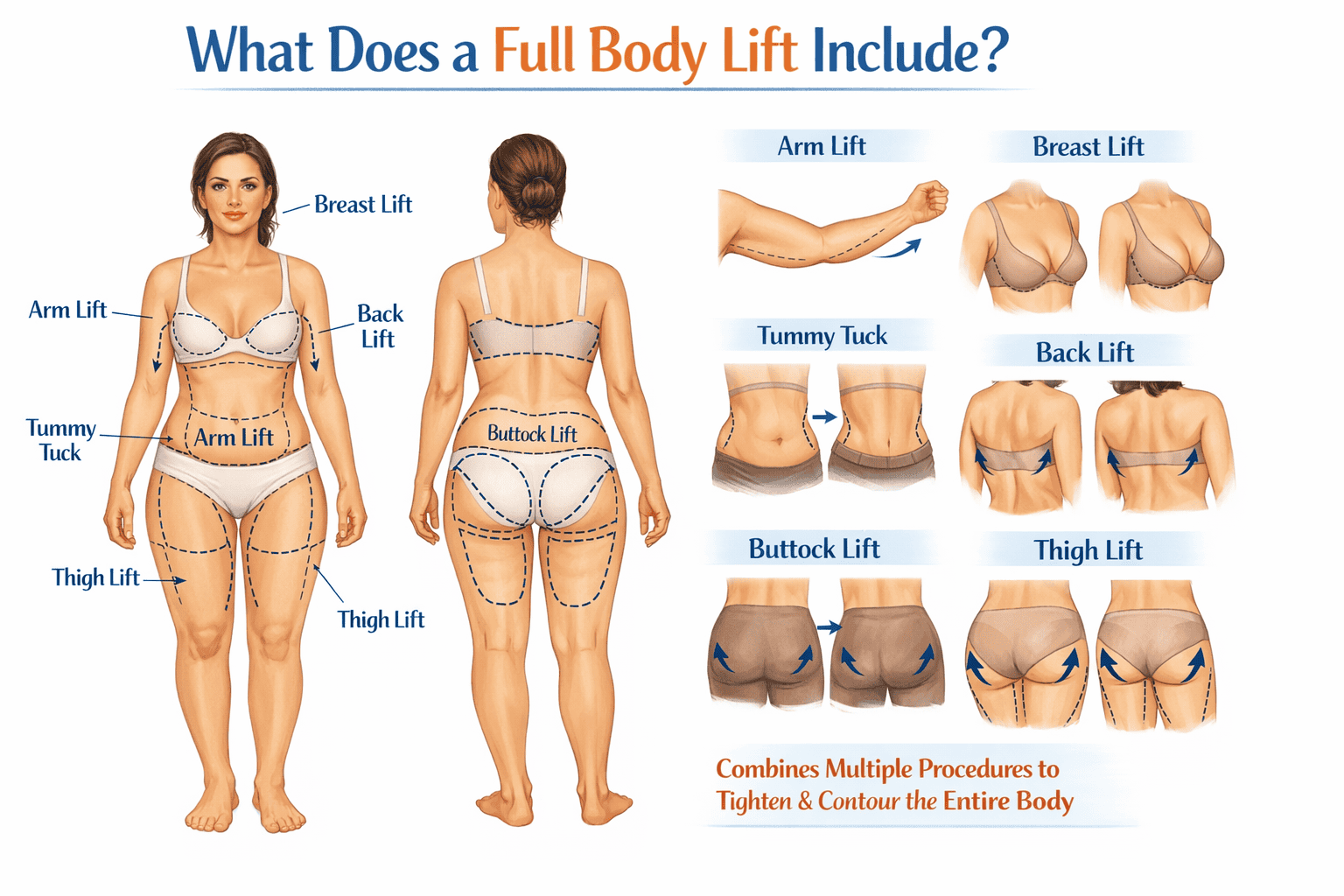 A full body lift surgey includes procedures like breast lift, arm lift, back lift, thigh lift and tummy tuck