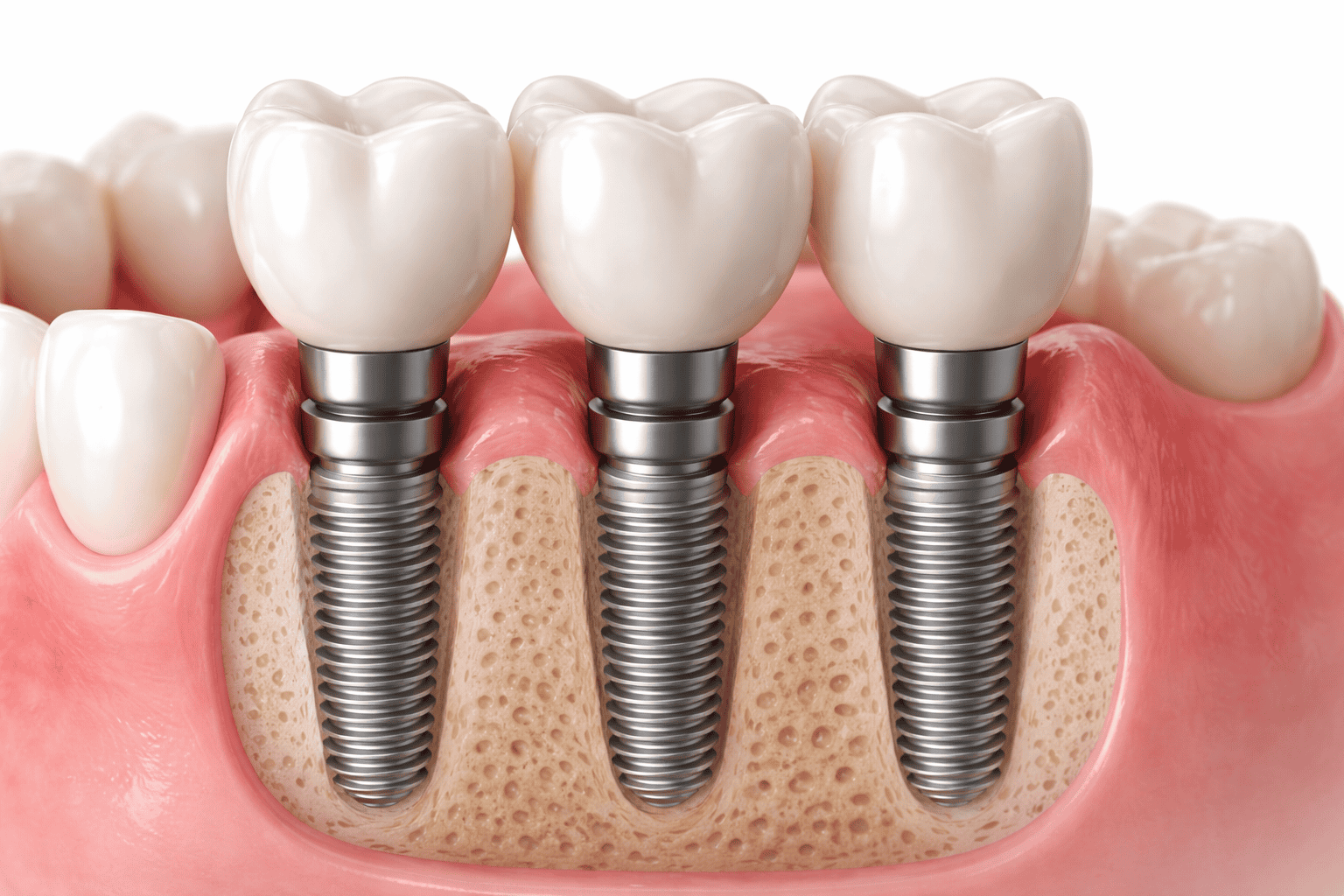 showing image of dental implants